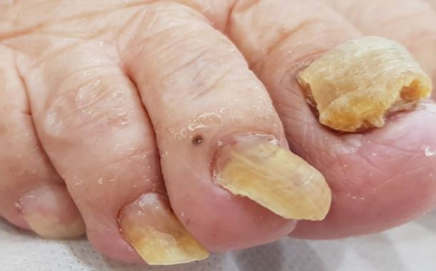 당뇨로 발 관리가 어려웠던 치료 전 사진