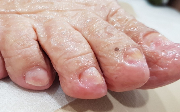 5개월 치료 후 정상 발톱으로 자란 사진