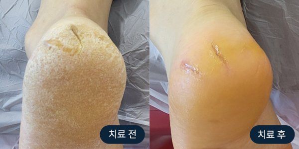발각질 관리 전후 사진