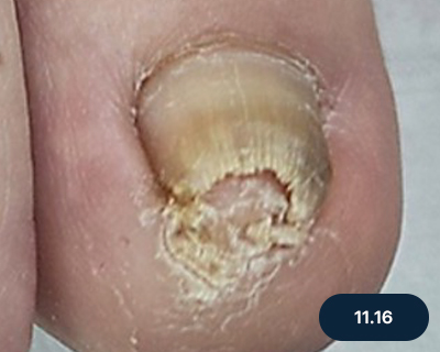 와이어 교정 치료 중 사진